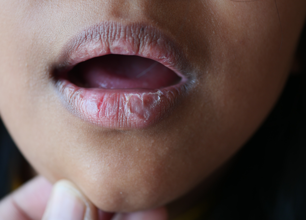 Descubra como manter os lábios hidratados e saudáveis com 5 dicas simples para o dia a dia. Cuide da sua saúde labial de forma prática e eficiente!