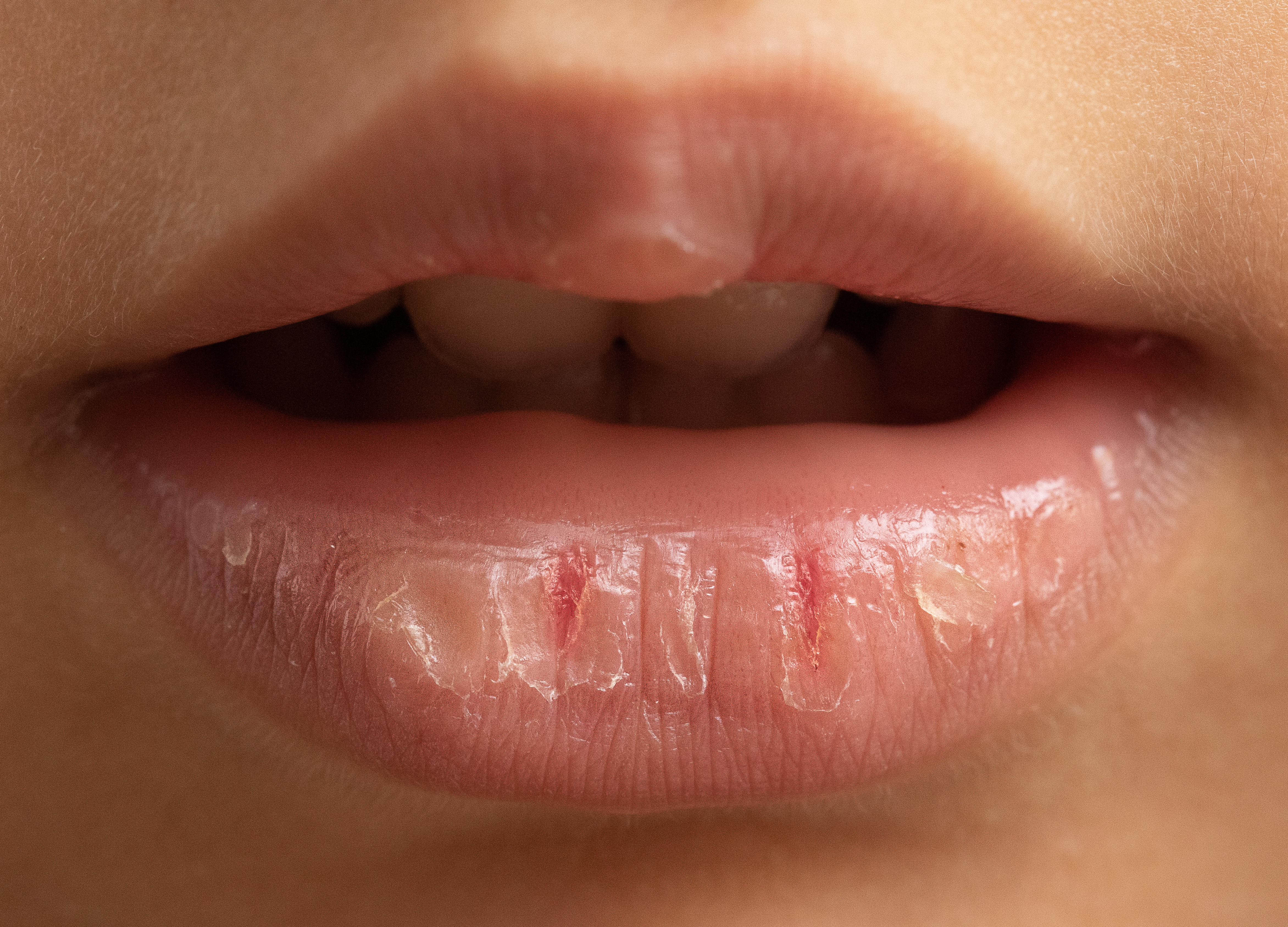 Descubra como manter os lábios hidratados e saudáveis com 5 dicas simples para o dia a dia. Cuide da sua saúde labial de forma prática e eficiente!
